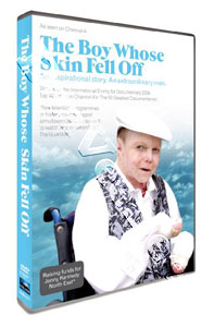 The Boy Whose Skin Fell Off (DVD)